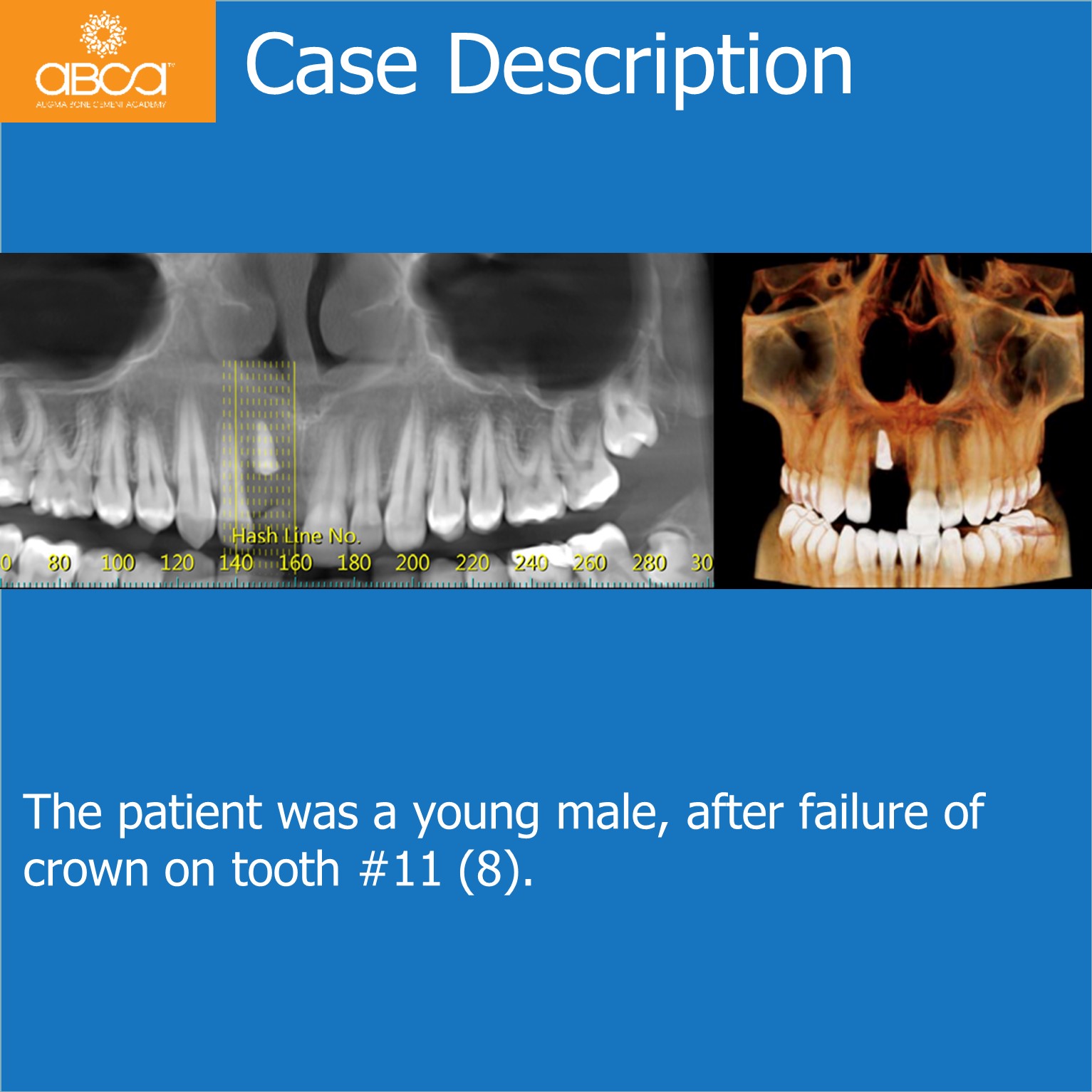 Implant and Augma in the Aesthetic Zone